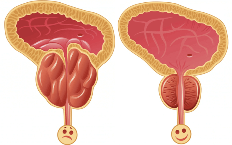 gizonezkoetan potentzia-arazoen arrazoiak